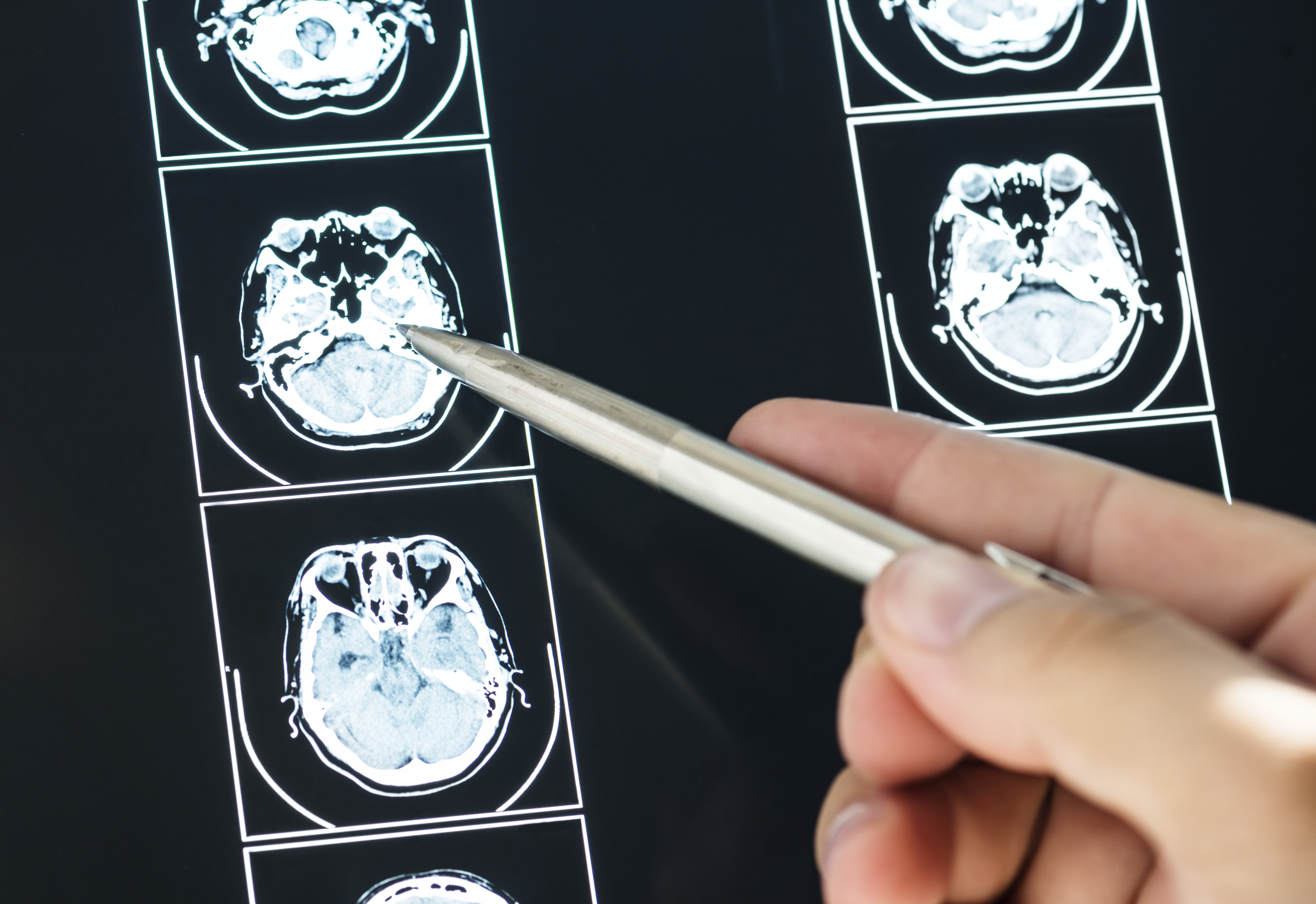 Justification of Urgent Brain CT scans at Palestinian Government Hospitals